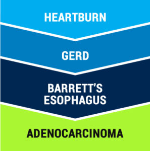 Barrett's Esophagus - Barrett's Disease