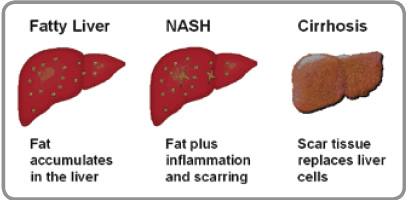 Fatty Liver, NAFLD, NASH, and Cirrhosis