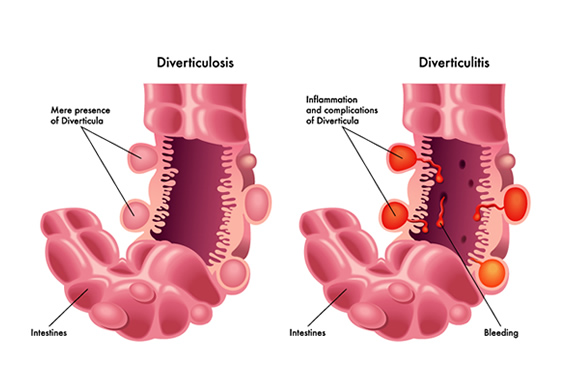 Gastroenterology Consultants of San Antonio - Diverticular Disease