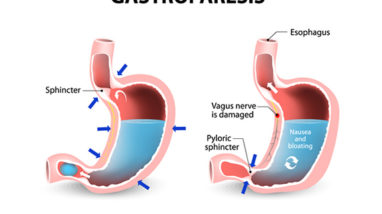 Gastroparesis