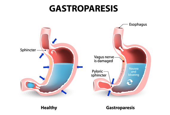 diabetic gastroparesis symptoms nhs
