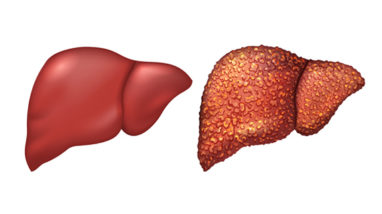 Liver Cirrhosis