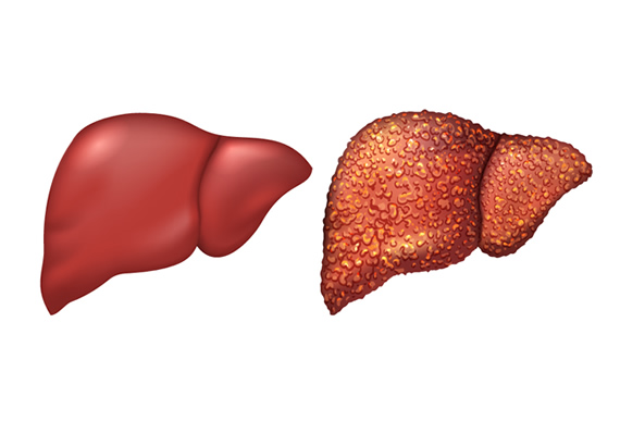 Gastroenterology Consultants of San Antonio - Liver Cirrhosis