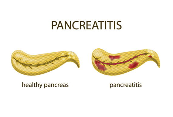 Gastroenterology Consultants of San Antonio - Pancreatitis