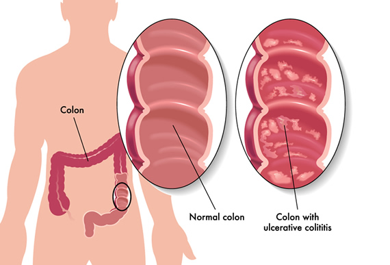 Gastroenterology Consultants of San Antonio - Ulcerative Colitis