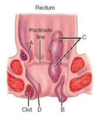 Treatment for external and internal Bleeding hemorrhoids