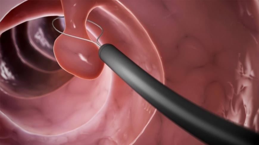 11 Colonoscopy Myths Debunked