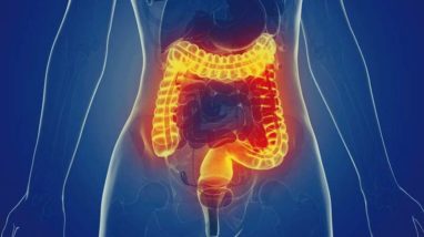 Learn the Truth about These 3 Diverticular Disease Myths