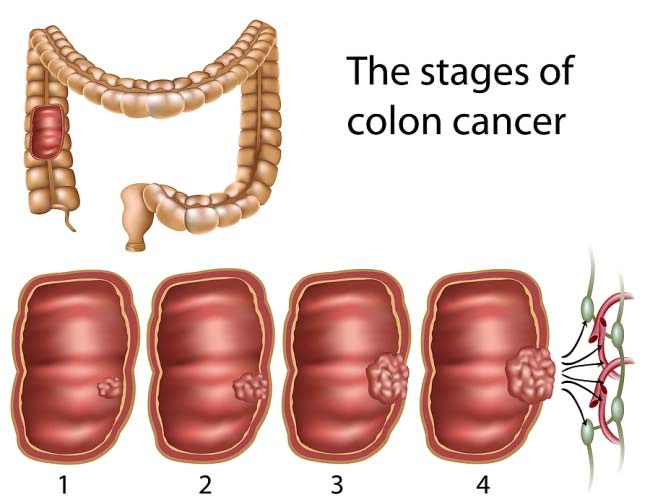Cologuard Test - Colon Cancer Stages