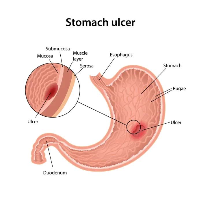 Melhores e piores alimentos para úlceras estomacais
