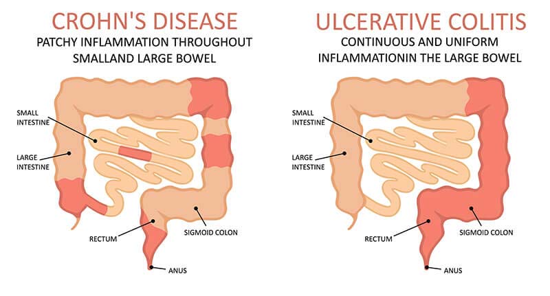 Crohns Disease Ultimate Guide Symptoms Diet Causes Treatment