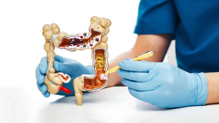 Polyps in Colon: What You Need to Know