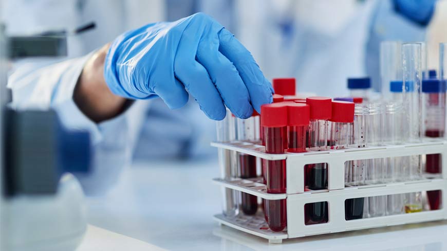 Blood Tests for Colon Cancer: Do They Work?