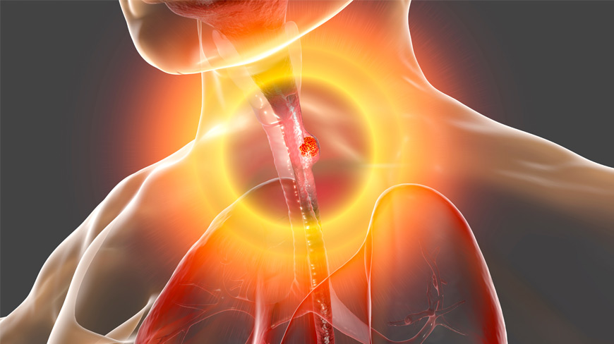 Esophageal Cancer Causes: What You Should Know