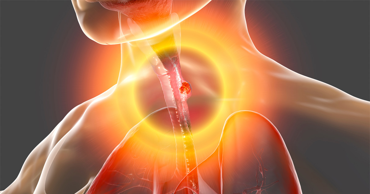Esophageal Cancer Causes: What You Should Know