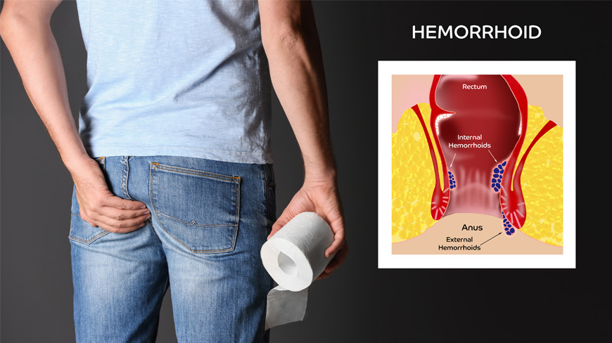 Internal Hemorrhoids: What You Should Know