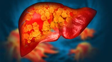 Fatty Liver Symptoms You Should Know