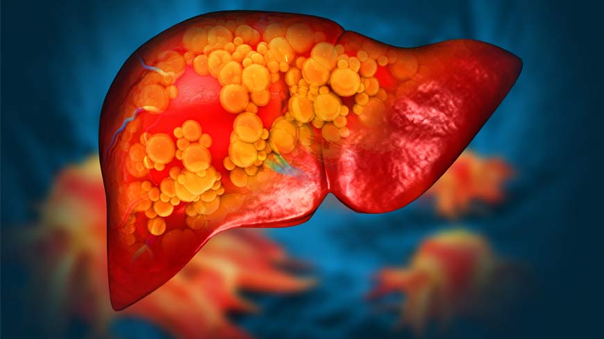 Fatty Liver Symptoms You Should Know